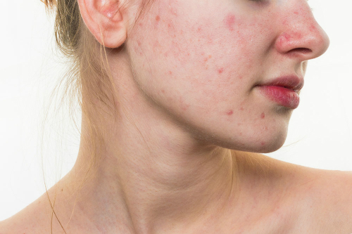 bị mụn trứng cá da ít lão hóa hơn