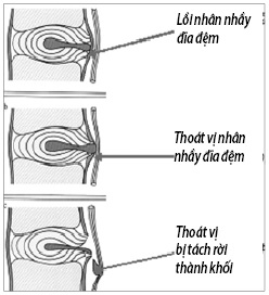 ảnh hưởng của việc thoát vị đĩa đệm